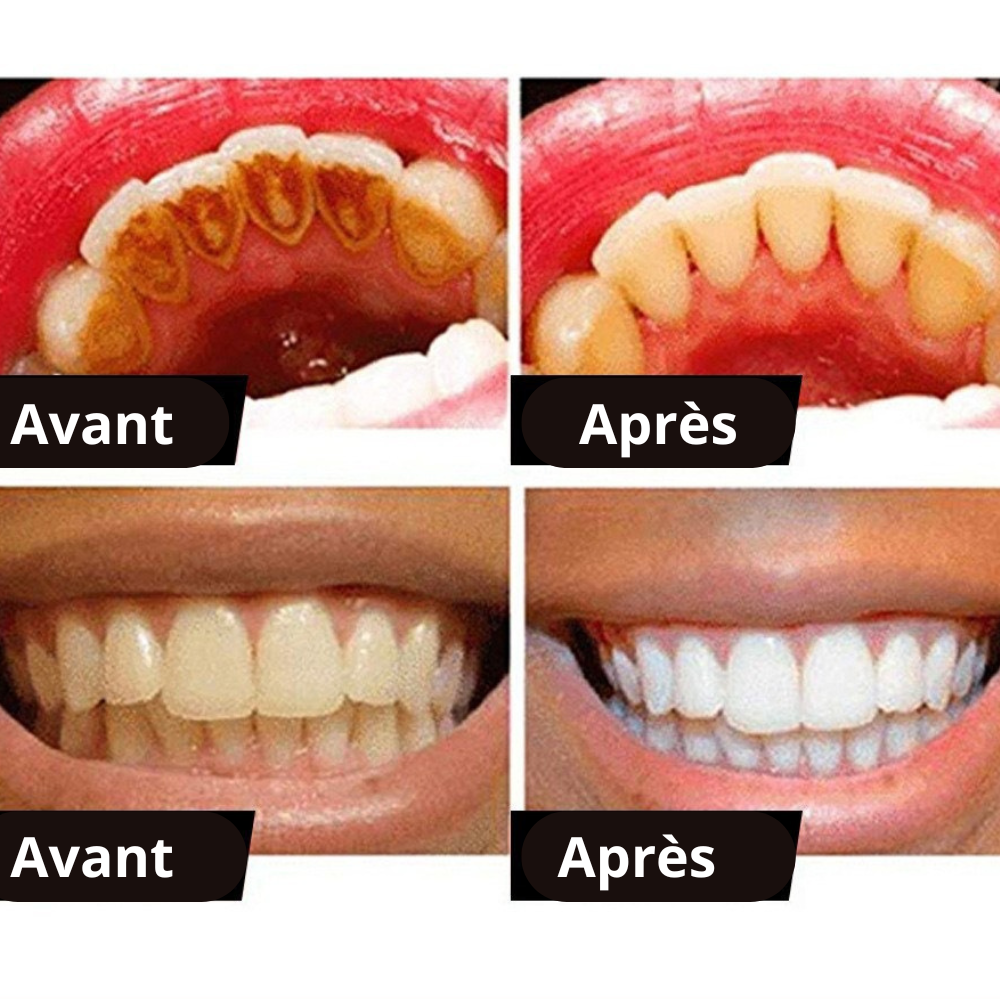Sérum Blanchissant pour les Dents